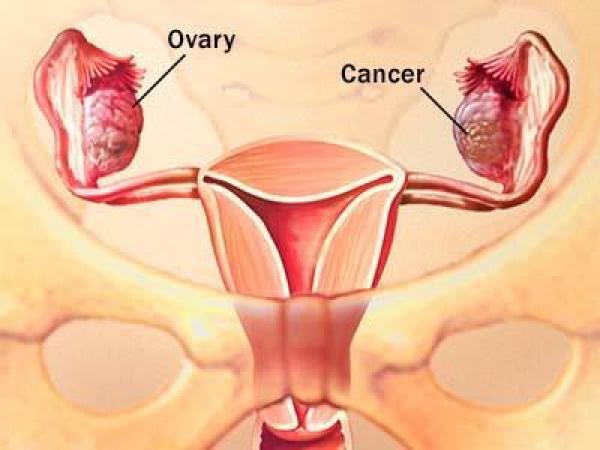 ovary cancer